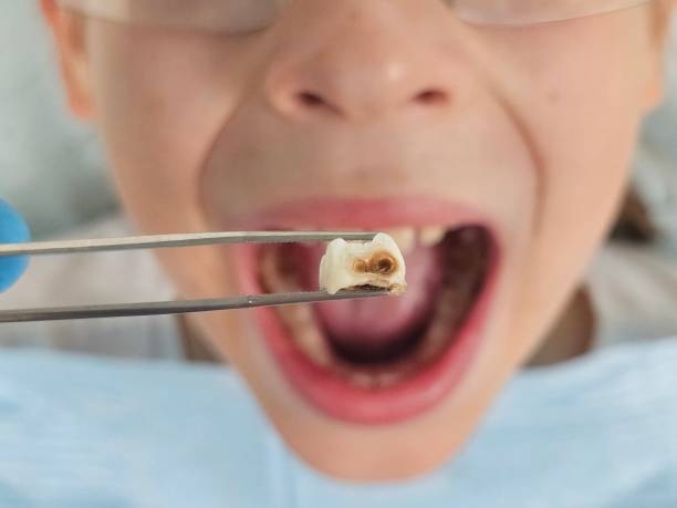 Best Emergency Dentist for Knocked-Out Tooth in Slocom, AL